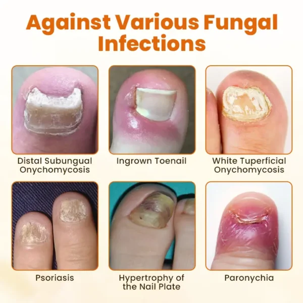 CVREOZ® FungiFix Bee Venom Nail Spray