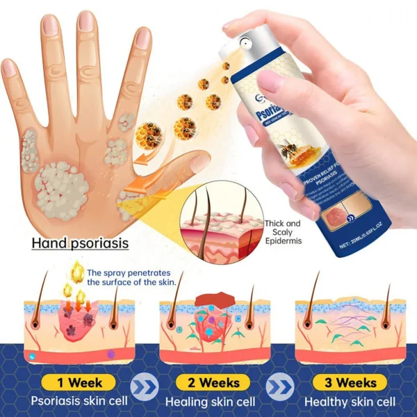 Cvreoz® Psoriasis Cure Bee Venom Treatment Spray