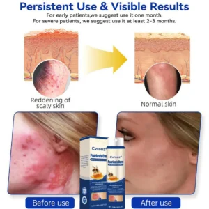 Cvreoz® Psoriasis Cure Bee Venom Treatment Spray