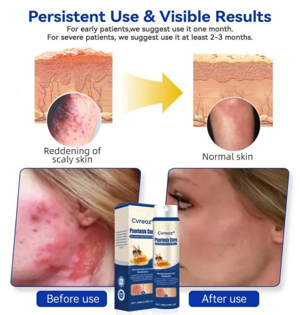 Cvreoz® Psoriasis Cure Bee Venom Treatment Spray