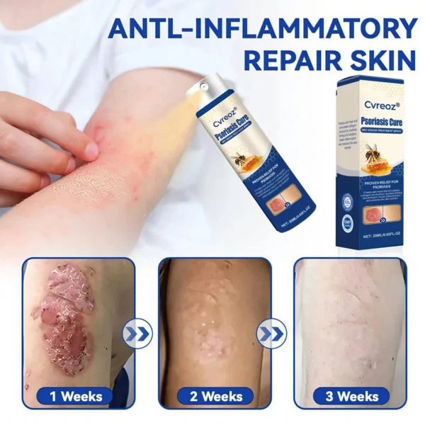 Cvreoz® Psoriasis Cure Bee Venom Treatment Spray