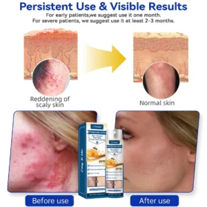 Cvreoz® Psoriasis Heal Bee Venom Spray