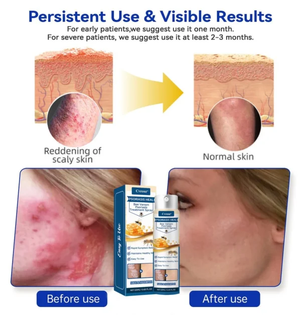 Cvreoz® Psoriasis Heal Bee Venom Spray