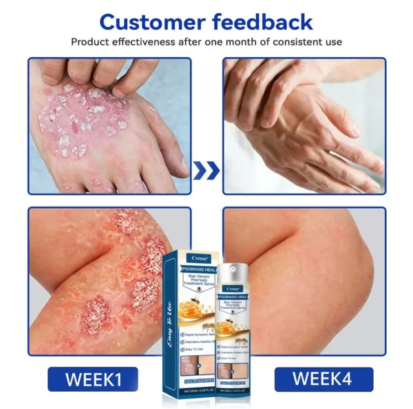 Cvreoz® Psoriasis Heal Bee Venom Spray