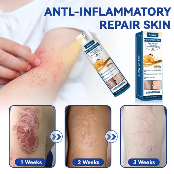 Cvreoz® Psoriasis Heal Bee Venom Spray