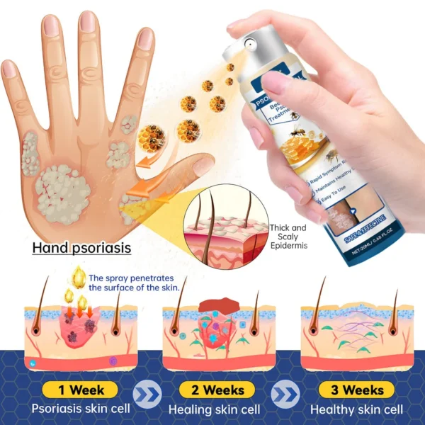Cvreoz® Psoriasis Heal Bee Venom Spray