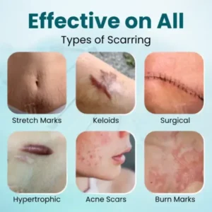 Cvreoz® Advanced Scar Gel