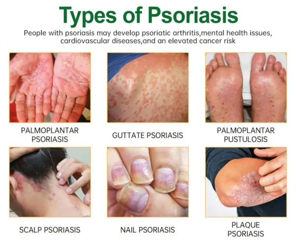 Cvreoz® Knotaway Psoriasis Cream