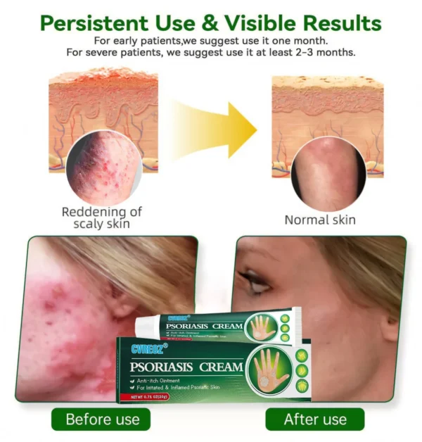 Cvreoz® Knotaway Psoriasis Cream