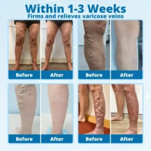 Cvreoz® VeinErase MicroNeedle Repair Patch