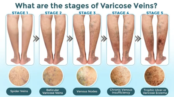 Cvreoz® VenaRestore MicroNeedle Vein Repair Patch