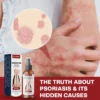 Cvreoz® DermSoothe Psoriasis Relief Spray