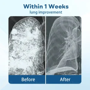 Cvreoz® DoubleNano Advanced Lung Detox Patch for Relief