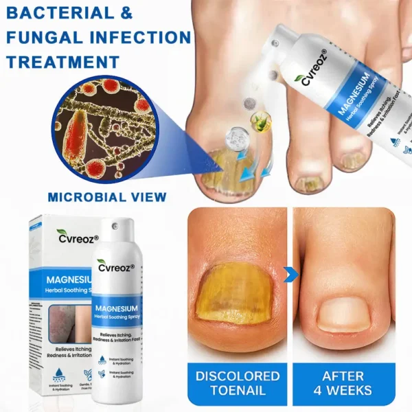 Cvreoz® Magnesium Herbal Psoriasis Spray