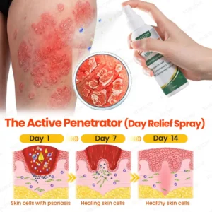 KUBOZN® Psoriasis Day & Night Repair System - 100% Steroid-Free Relief Duo for Plaques, Scaling & Itch