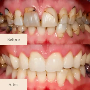 LOVILDS™ Advanced Enamel Repair & Whitening Kit (Includes Free LED Mirror)